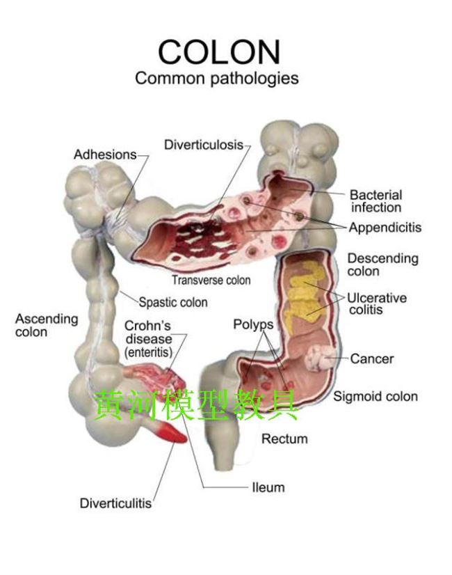 Mô hình bệnh lý ruột kết mới Mô hình bệnh lý đại tràng Mô hình ruột già Mô hình giải phẫu đường ruột Mô hình giải phẫu đường ruột - Chế độ tĩnh