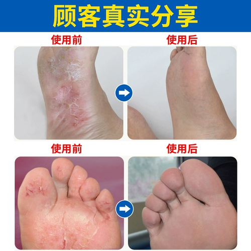 修正 Спортсменная спрей, очищающий легкий, пудры, мазь, запах ног, волдыри, гнилые ноги стерилизация.