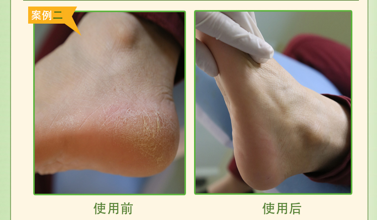 Tẩy tế bào chết bộ phim chân màng da chết cũ tay và chân dán chống khô tay và chăm sóc bàn chân thiết lập nhà sửa chữa gót chân ủ lột da chân