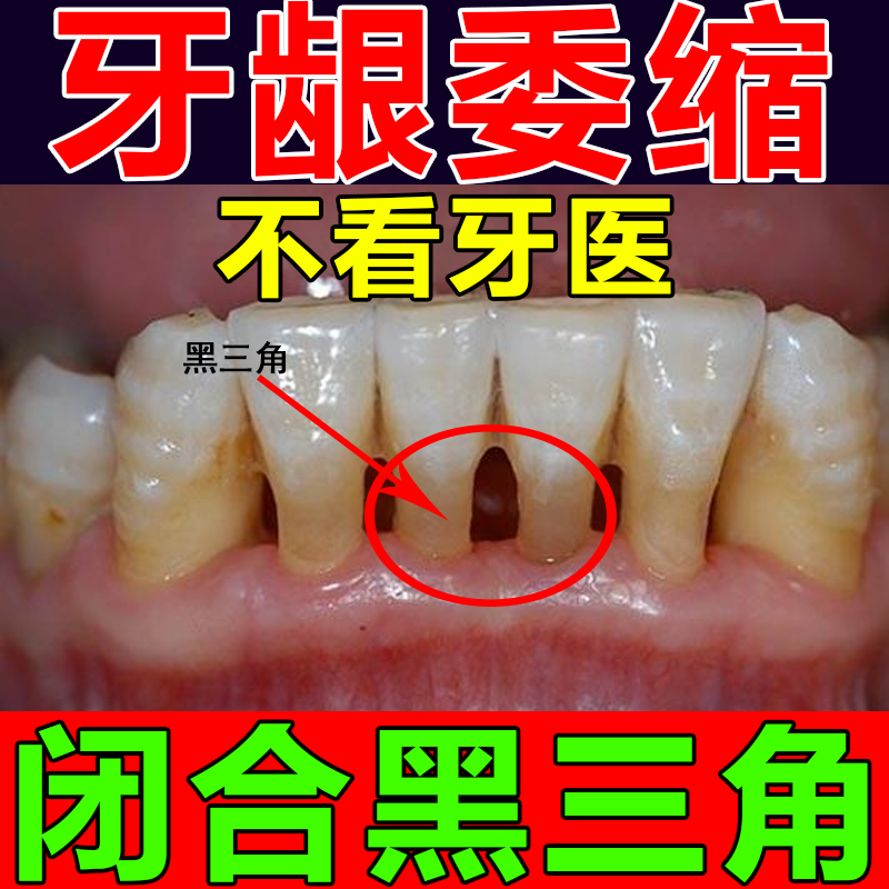 Treatment of gum recession repair regeneration artifact periodontitis bleeding teeth loose teeth special medicine solid tooth powder spray
