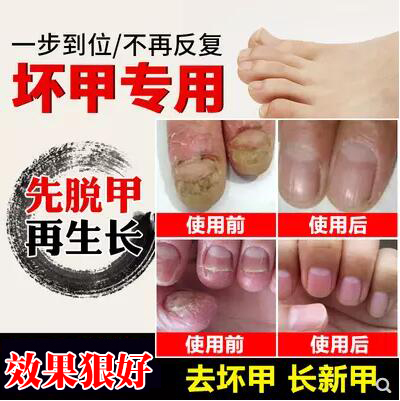 Gray Nail Health Toe Specialized Nail Fungus Remover for Thickened and Yellowed Toenails, Magic Remedy for Softening and Removing Nail Fungus