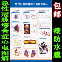 Acute coronary syndrome electrocardiogram illustration Human visceral anatomy myocardial infarction thrombosis obstruction hospital wall chart poster