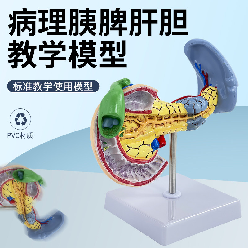 教学仿真 病变胰脾肝胆十二指肠模型 病理胰腺标本 胰脾肝胆解剖