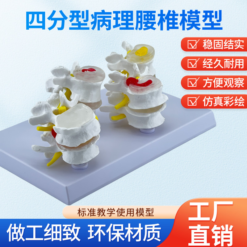 四阶段病变腰椎模型 病理骨骼模型 变形骨骼病态腰椎脊柱脊椎模型