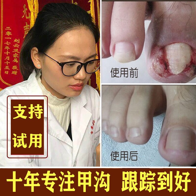 Zhang's Nail Groove Treatment Ointment for Ingrown Toenail Inflammation, Special Softening Agent for Toenail Polyps Removal, Solution for Nails Growing into the Flesh, Eliminating Swelling and Removing Granulations