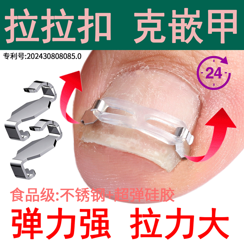 Lala's Nail Correction Device for Ingrown Toenails, Nail Correction Stickers for Correcting Toenails That Grow into the Flesh