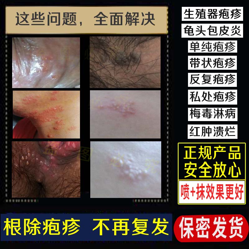 治療男女性病皰疹剋星一掃光淋病梅毒預防殺菌液感染尿道炎流膿藥 治療男女性病皰疹剋星一掃光淋病梅毒預防殺菌液感染尿道炎流膿藥