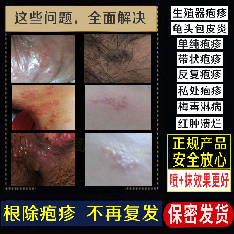 治療男女性病皰疹剋星一掃光淋病梅毒預防殺菌液感染尿道炎流膿藥