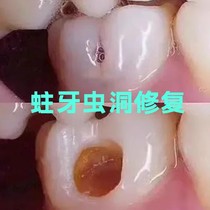 (Recommendation for best-selling products) Say goodbye to cavities and cavities. The tool for cavities and bad teeth is available for both men and women.