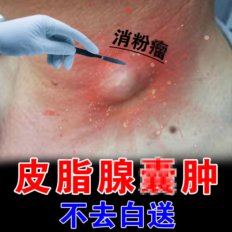 Sebaceous cyst cream acne removal Bartholin's Bartholin cyst removal cream tendon sheath popliteal fossa acne artifact
