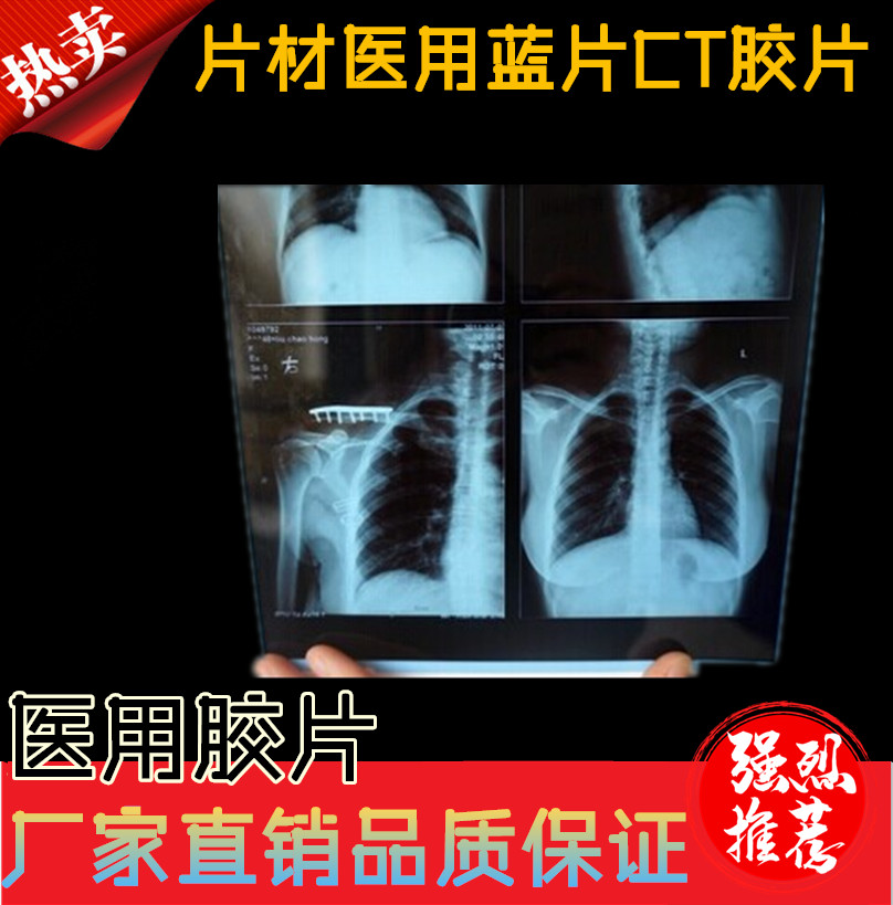 Blue - based radiology printing film Dental Fracture X-ray DR CR CT