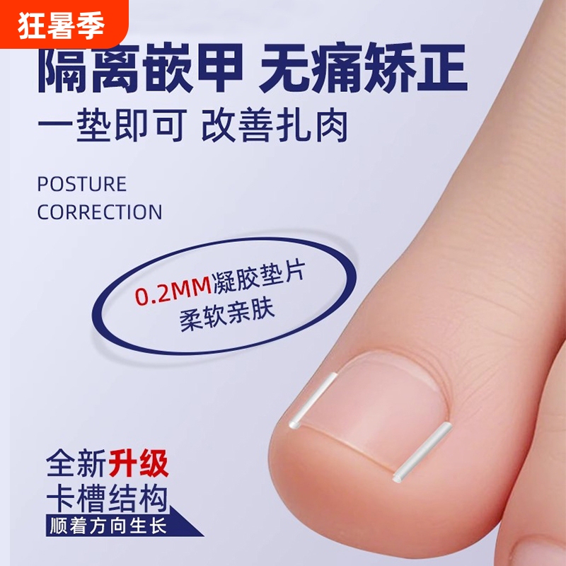 Ingrown Toenail Corrector Device to Correct Nails That Grow into the Flesh, Isolation and Filling Pads for Big Toe Nails Ingrown Toenail Corrector Device to Correct Nails That Grow into the Flesh, Isolation and Filling Pads for Big Toe Nails