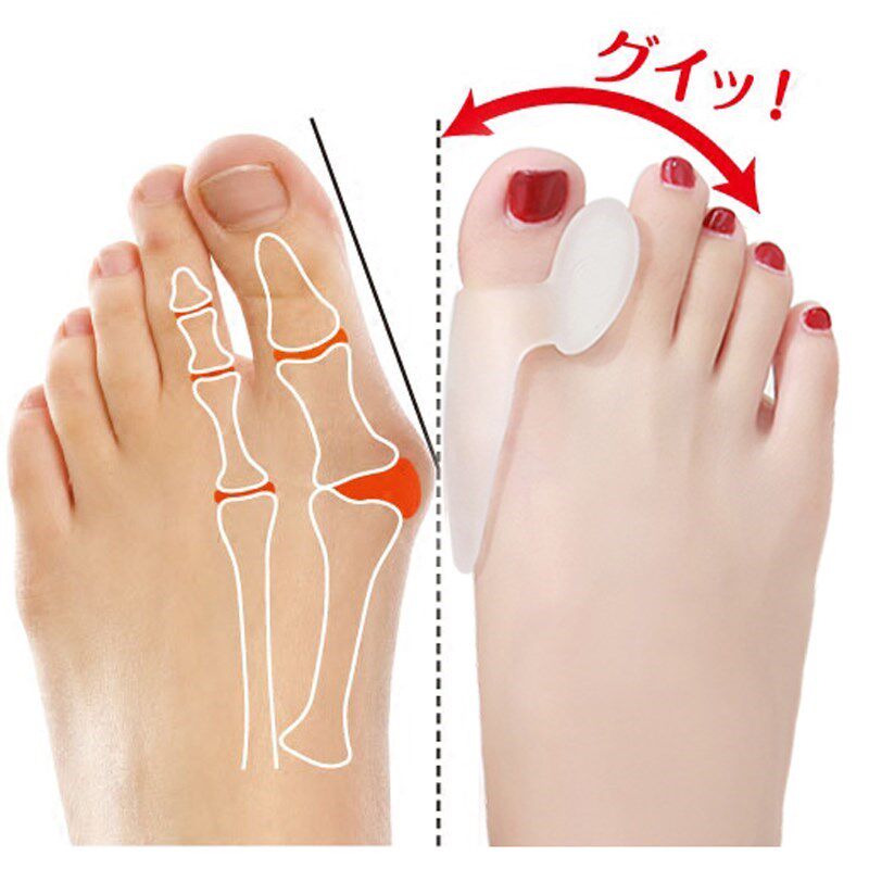 Correction of foot shape artifact children's nail protector ankle corrector foot valgus big foot bone valgus correction adult