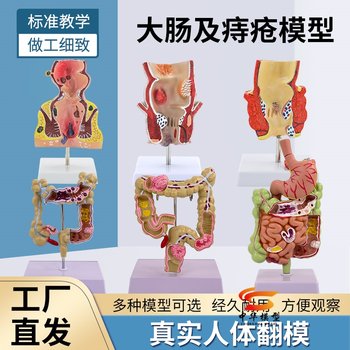 Large Intestine Pathology Model, Rectal Model, Gastrointestinal Lesion Anatomy Model, Intestinal Disease Human Colon Lesion Model
