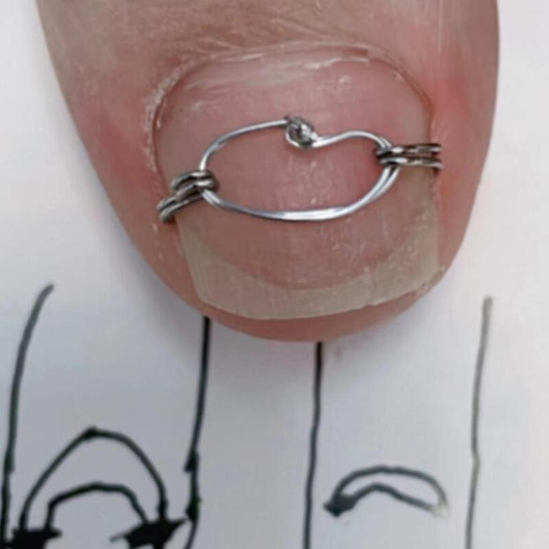 Ingrown Toenail Correction Hook, Nail Correction Clip, Ingrown Toenail Correction Hook, Nail Correction Patch, Nail Curling Inwards, Toenail Growing into the Flesh, Toenail Piercing the Flesh Ingrown Toenail Correction Hook, Nail Correction Clip, Ingrown Toenail Correction Hook, Nail Correction Patch, Nail Curling Inwards, Toenail Growing into the Flesh, Toenail Piercing the Flesh