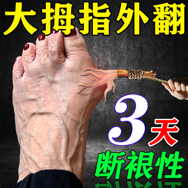 (more than ten thousand people have been corrected) Thumb Valgus ointment Thumb Valgus Straightener Big Mother Toe Valgus Sticker-Taobao