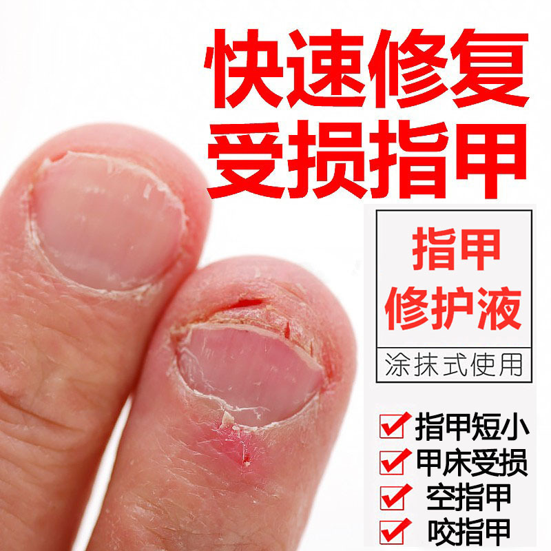 Damaged Nails Thickening Repair Liquid for Uneven Growth, Nail Repair Liquid, Regenerating Nutrient Oil for Finger and Toenail Regeneration Damaged Nails Thickening Repair Liquid for Uneven Growth, Nail Repair Liquid, Regenerating Nutrient Oil for Finger and Toenail Regeneration