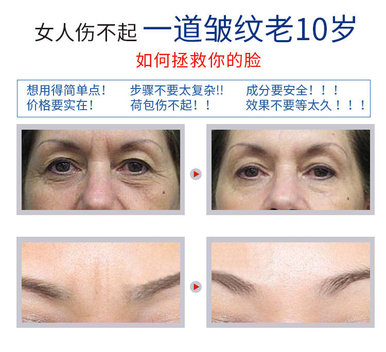 日本川字紋去除神器提拉緊致淡化眉心紋正品眉間貼去皺紋法令紋貼 露天拍賣