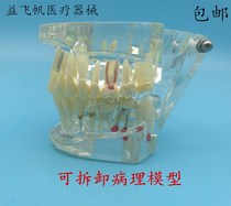Dental Material Lian Bridge Repair Model Integrated Pathological Model Partial Removable Planter Repair Model