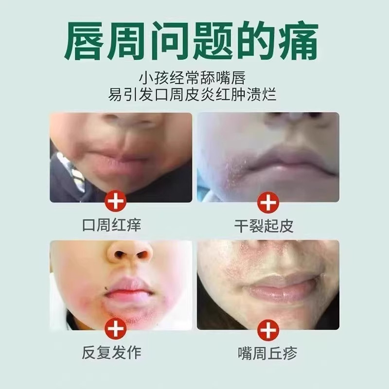 羊胡子疮不舔嘴!口周唇炎润唇膏怎么选?-润唇膏-淘宝百科网