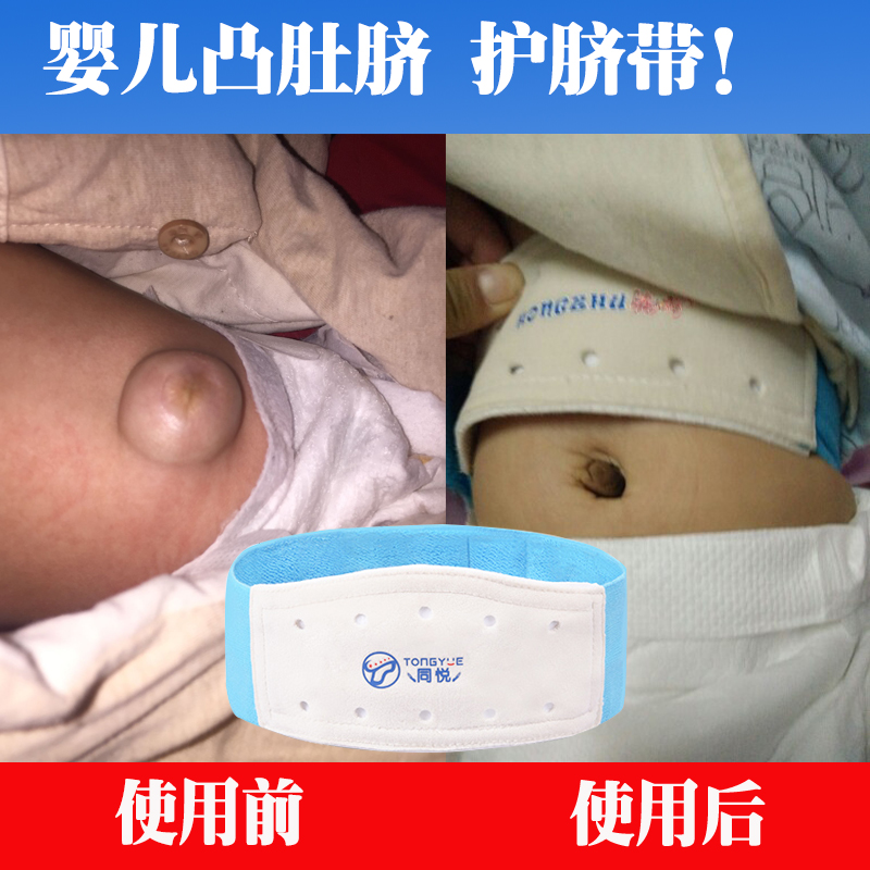 Baby convex navel belt Newborn belly guard drum belly breathable hernia bag umbilical cord 0-6 months gas navel patch