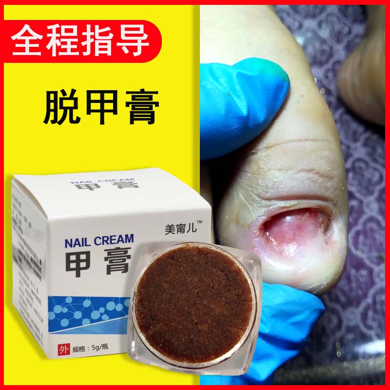 Thick Nail Removal Cream, Nail Softening Cream, Quick Removal of Thick Nails, Empty Nail Removal Cream, Pedicure Shop, Foot Bath Shop
