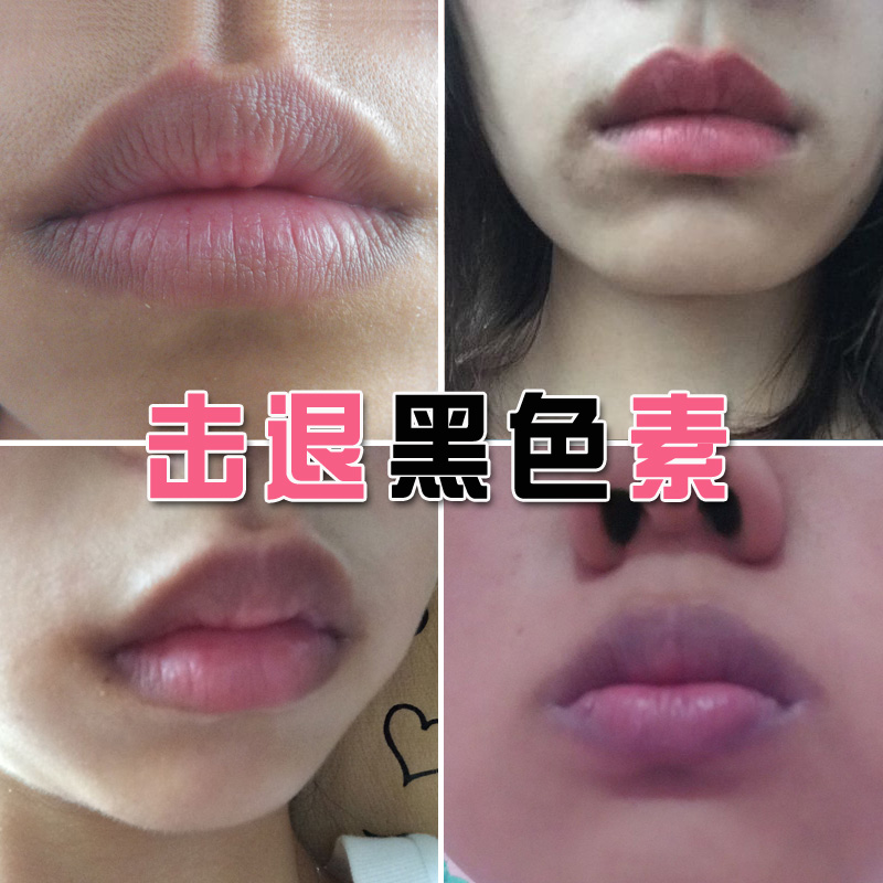 Go to Black Mouth Corner Black Pigment Lip Macular tip Precipitated Hair Dark Lips Week Down Lip Gloss Lip Care