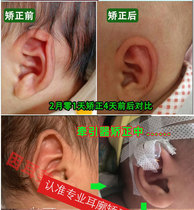 Baby ear shape correction patch ear orthotics ear patch ear patch newborn baby auricle orthosis baby