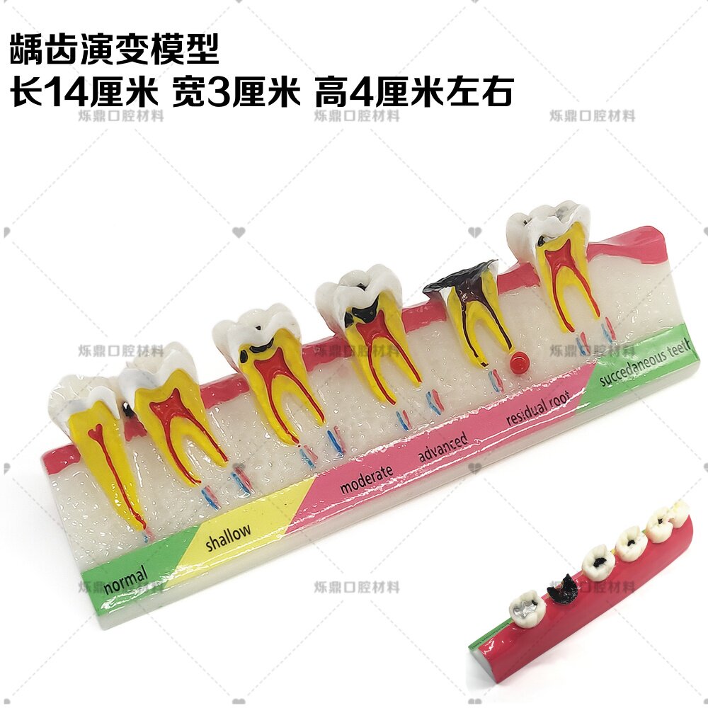 烁蒂牙科牙模口腔龋齿演变牙周炎讲解分析模型学习教学医患沟通
