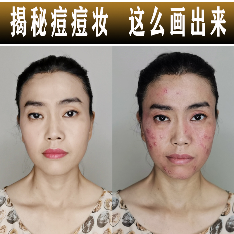 Fake Acne Makeup, Simulated Acne Scars, Fake Allergic Skin Problems Set, Skin Wax, Special Effects Makeup, Skin Bruising
