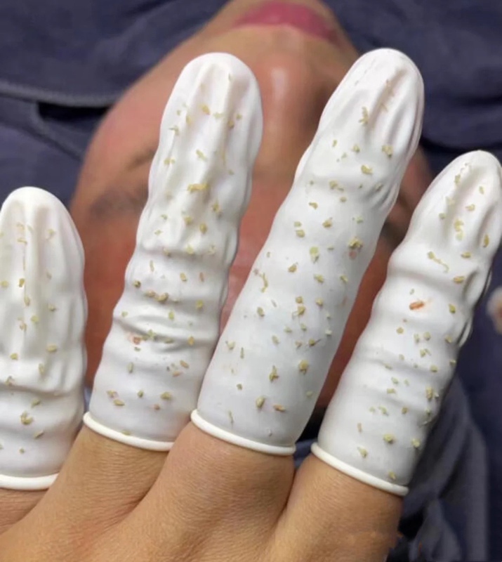 Latex Finger Cots, Disposable Beauty Salon Special Tool for Removing Acne and Squeezing Pimples, Magic Tool for Tattoo and Nail Art Shops Latex Finger Cots, Disposable Beauty Salon Special Tool for Removing Acne and Squeezing Pimples, Magic Tool for Tattoo and Nail Art Shops
