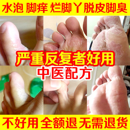 Beriberi cream Miao Fang Shuning sterilization stop itchy feet rotten feet have bubbles in addition to foot odor Feet peeling cracking dry