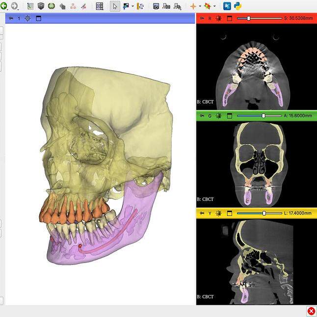 3d slicer/VTK/ITK医学编程开发 深度学习分割墨西哥定制
