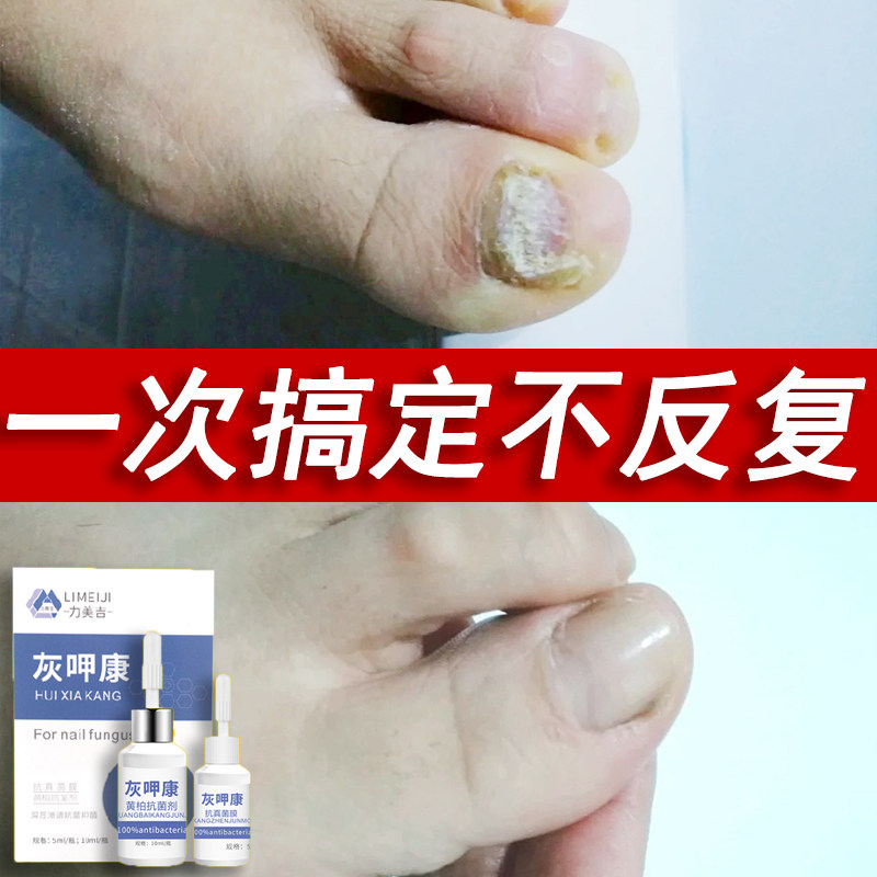 Bad Nails Thickened Grey Nail Toe Chia Hollow Chia Chia separated hand nail hair yellow thickeners Thicker Decchia essential oil liquid Non-repair