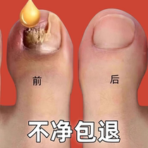 Tongrentang hot sale (grow new nails in seven days). One drop of it can turn bad nails into good ones and grow new nails. It can inhibit bacteria without removing nails.