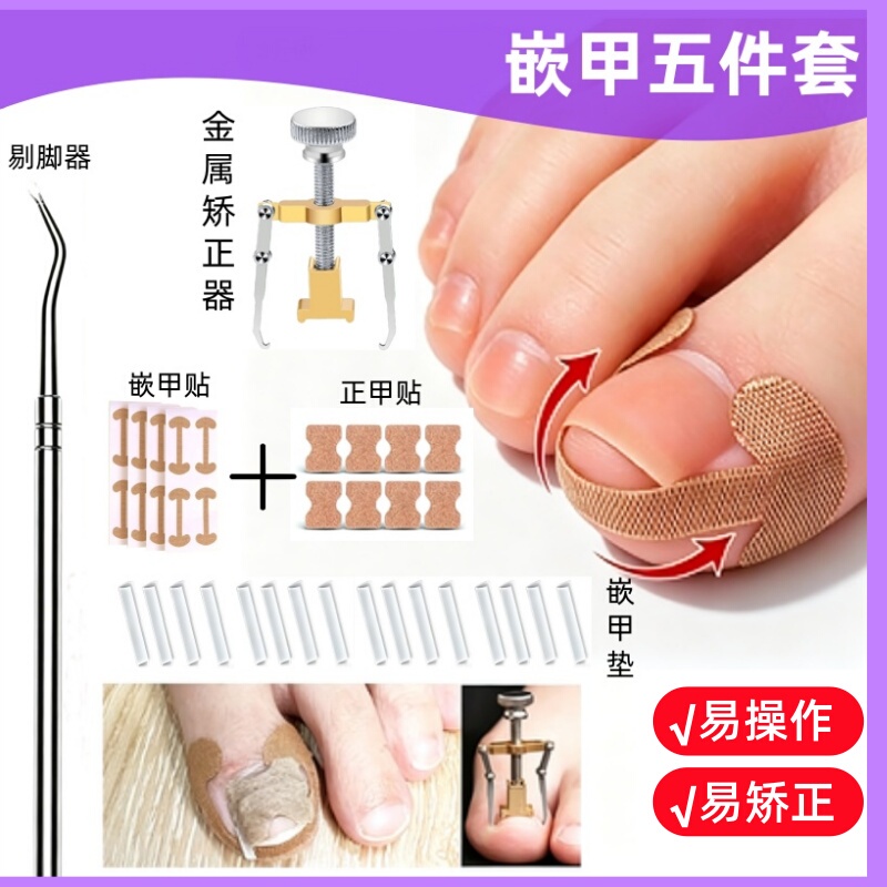 White Isolation Pads for Correcting Ingrown Toenails and Preventing Toenails from Growing into the Flesh