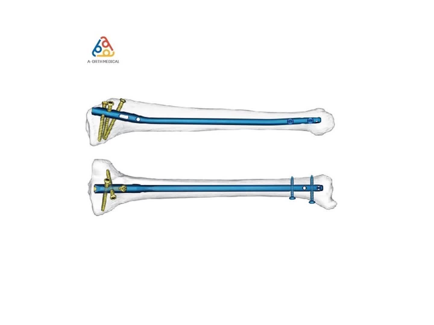 Hot Titanium Expert Tibial Intramedullary Interlocking Nail Of