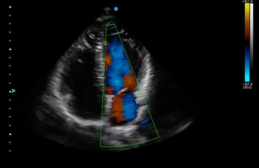 эхокардиография презентация. эхокардиография сердца тканевой допплер. цветовой допплер эхокг.