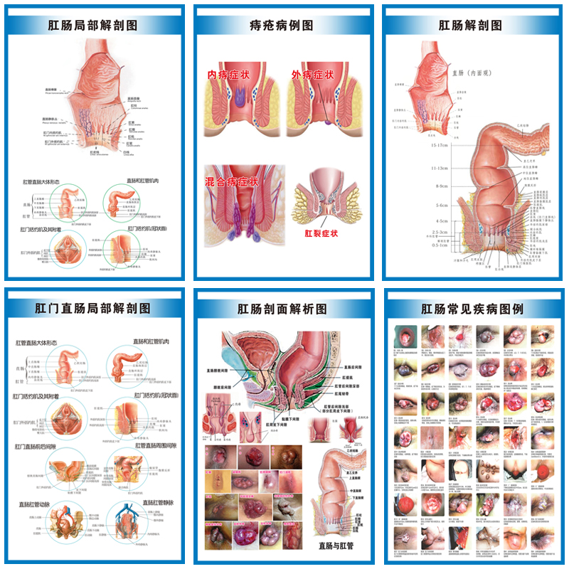 Anal Bowel Common Haemorrhoids Disease Picture Cases Wall Stickers Anorectal Anatomical Picture Hospital Wall Chart Advertising Posters Advertising Posters