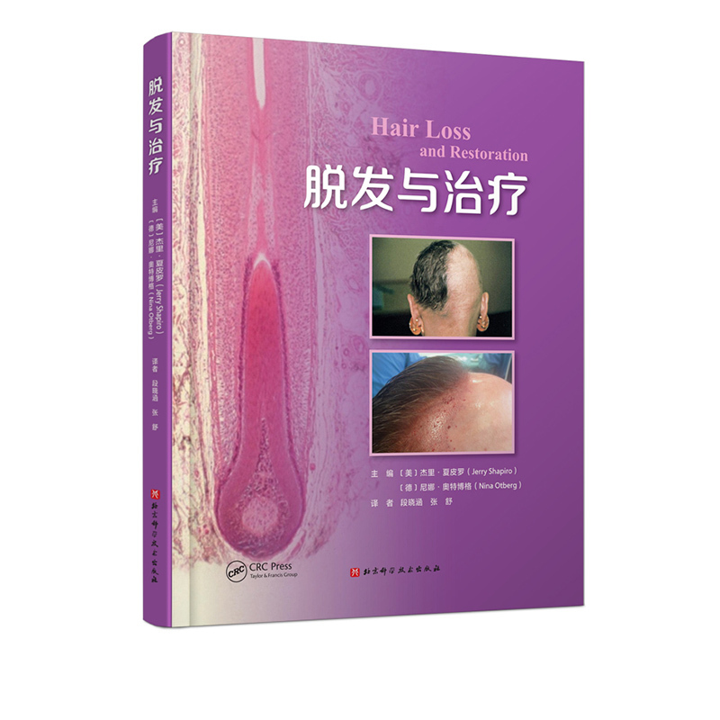 Hair Loss and Treatment Hair Skin Alopecia Areata Scarring Diagnostics Hair Transplantation Beijing Science and Technology