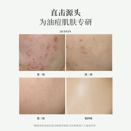 Импортный гель алоэ вера, увлажняющий тонер с салициловой кислотой от черных точек, анти-акне, контроль жирного блеска, сужает поры