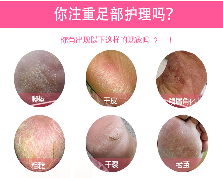 Tẩy tế bào chết bộ phim chân phim chết da ông già tay thanh chống khô chăm sóc bàn chân thiết lập nhà sửa chữa gót chân mà không lột kem trị nứt nẻ chân tay
