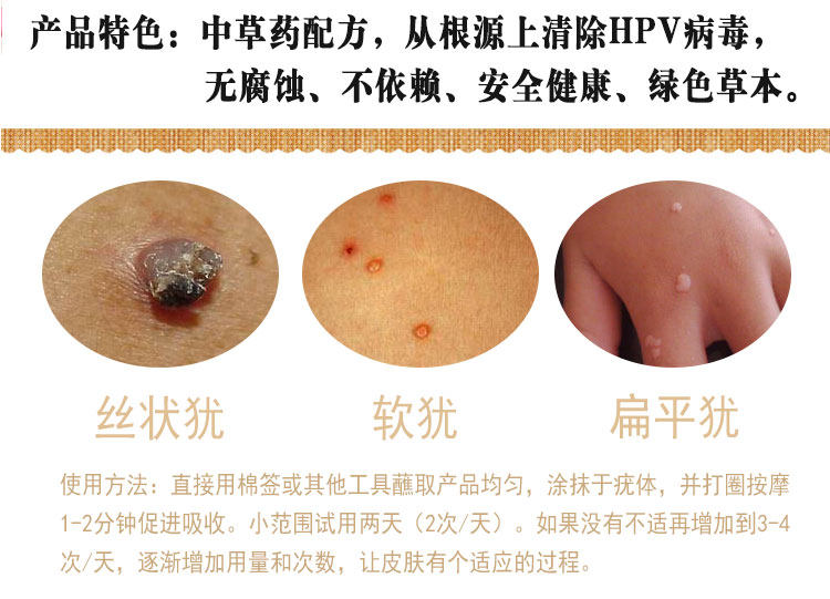 疣子,尖锐疣,瘊子和疣的区别_文秘苑图库