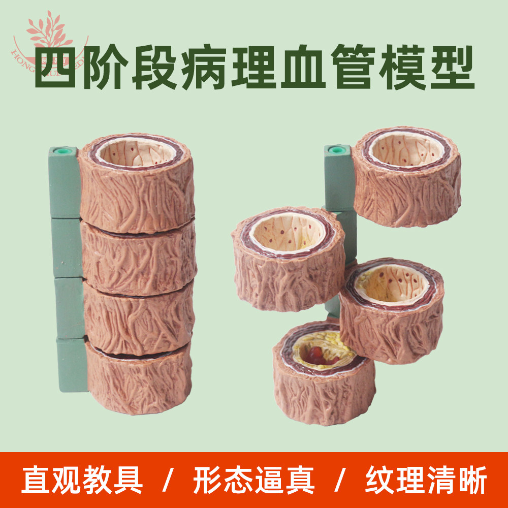 放大十倍动脉粥样硬化四个不同阶段病理演变医用血管硬化模型