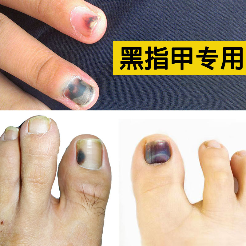 Special Medicine for Black Nails, Blood-Stained Nails, Blackened Fingernails, Blackened Toenails, Blackened Nails Due to Pressure, Nail Moles, and Bruised Nails Special Medicine for Black Nails, Blood-Stained Nails, Blackened Fingernails, Blackened Toenails, Blackened Nails Due to Pressure, Nail Moles, and Bruised Nails