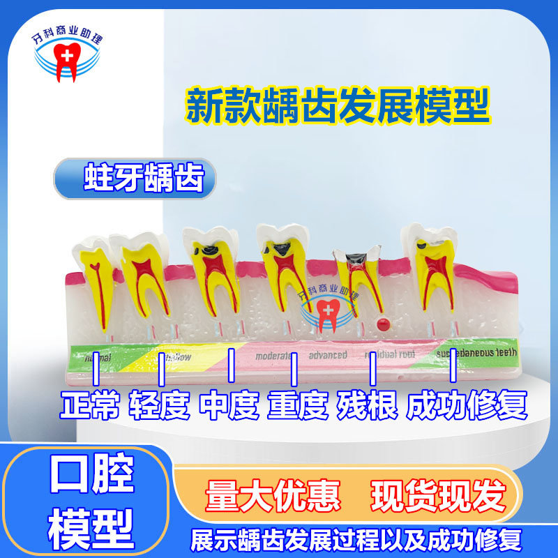 牙齿模型病理蛀牙分类牙龈牙周受损口腔展示龋齿变重过程龋齿发展