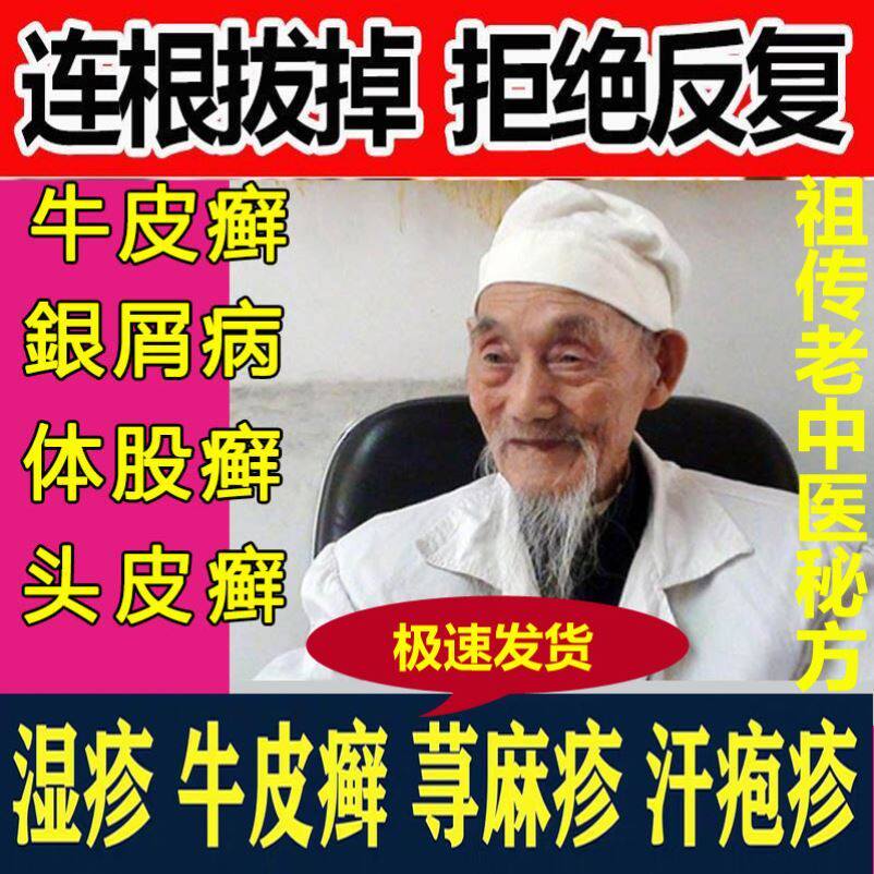 Skin Disease External medicine Gufang psoriasis silver Xiao Psoriasis External head scalp Bull Fatigue n