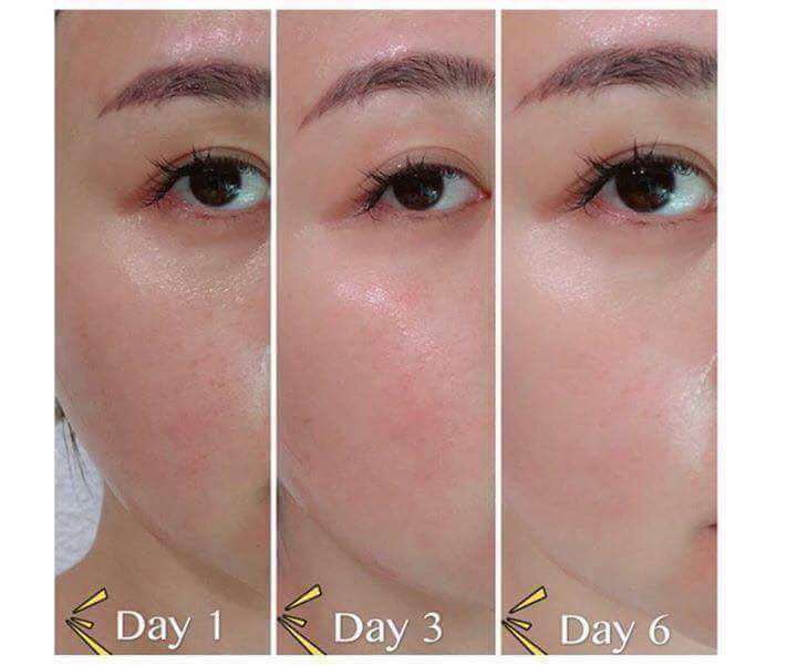 现货 香港皮肤科医生推荐 法国Myrtus 8 M8皮秒