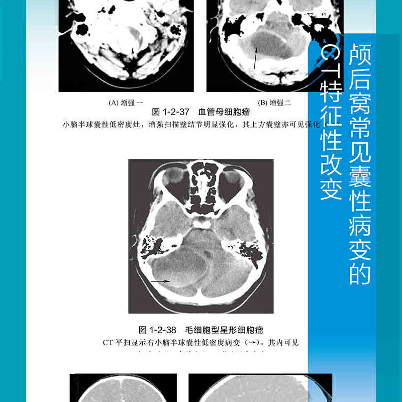 🔍医学影像界的宝藏书！《CT鉴别诊断一点通 第4版》带你一目了然松果体区疾病-影像医学-淘宝好物网