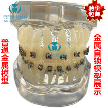 Orthodontic model correction model metal self-locking metal bracket comparison display model doctor-patient communication